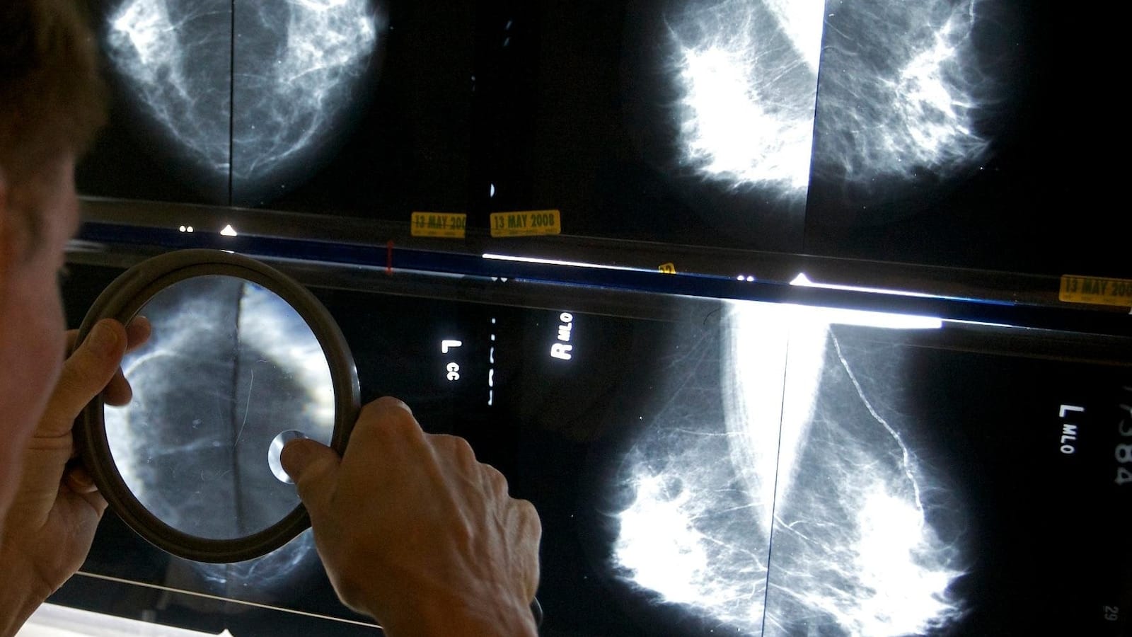 Mammograms should start at 40 to address rising breast cancer rates at younger ages, panel says