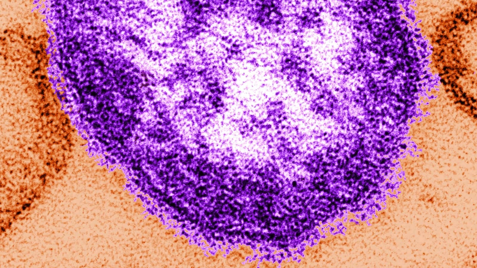 West Virginia confirms first measles case since 2009